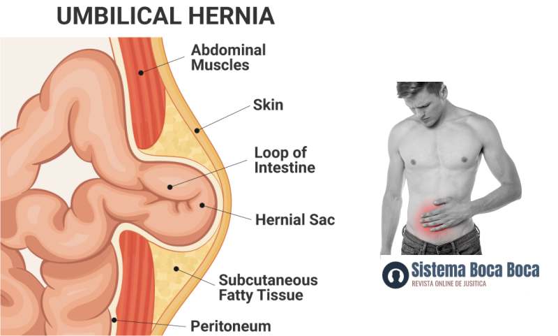 La anatomía y la predisposición genética de la hernia en hombres